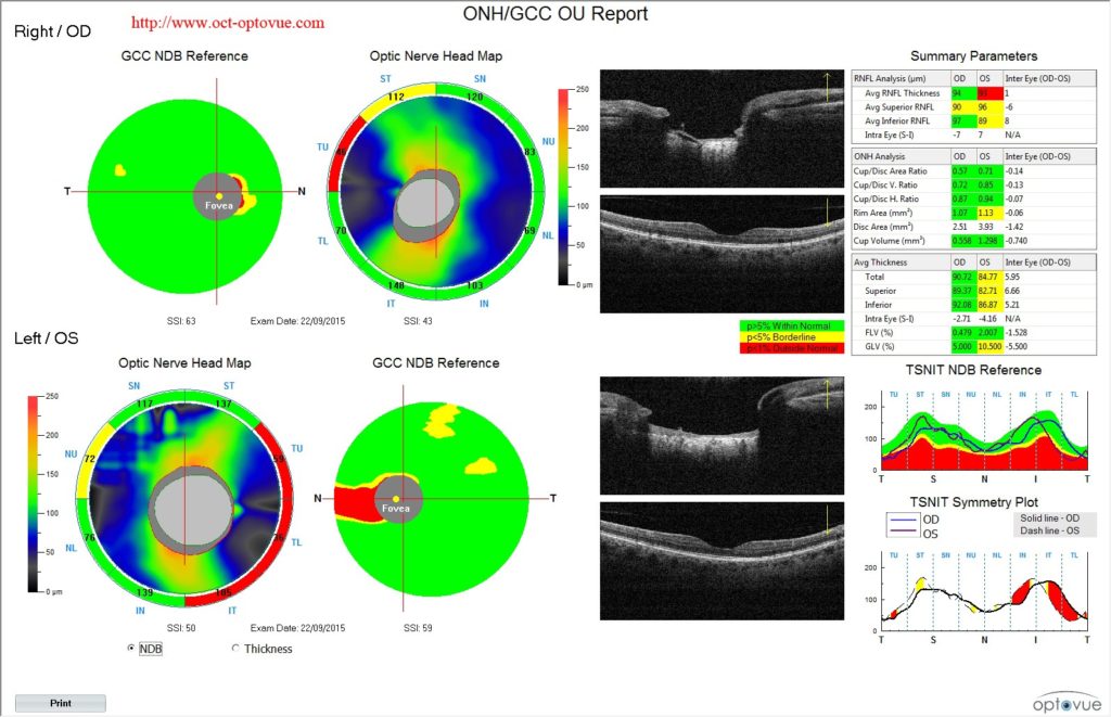 analyse oct nerf optique