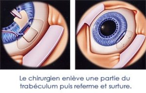 chirurgie glaucome