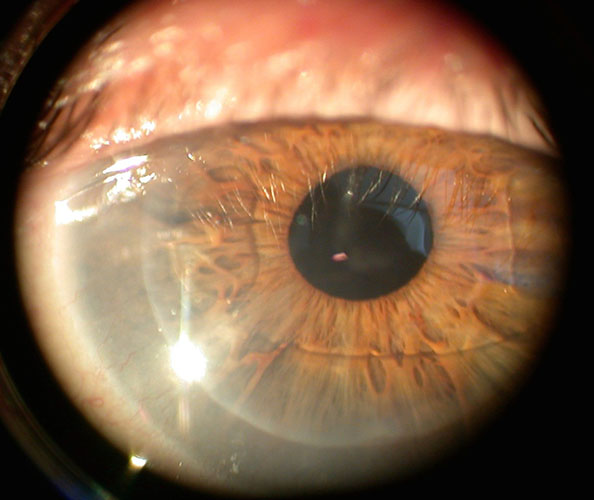Œdème de cornée - cornea guttata - Ophtalmo Trocadéro